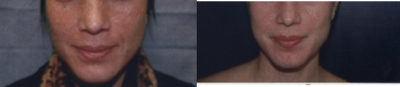 VI Peel before and after photo