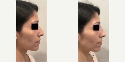 Voluma before and after photo