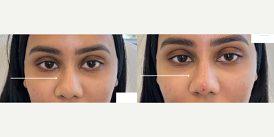 Nonsurgical Nose Job before and after photo