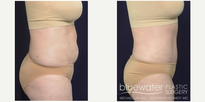 Tummy Tuck before and after photo