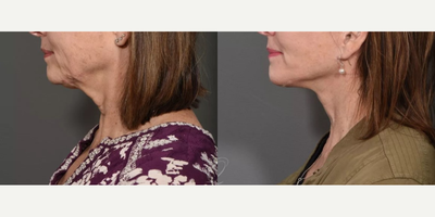Chin Liposuction before and after photo