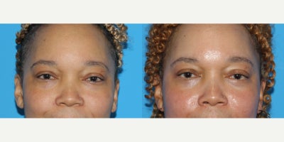 Eyelid Surgery before and after photo