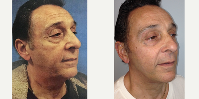 Neck Lift before and after photo