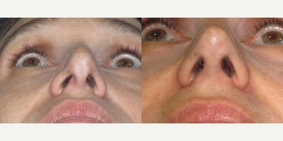 Revision Rhinoplasty before and after photo