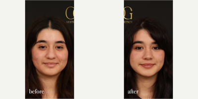 Rhinoplasty before and after photo