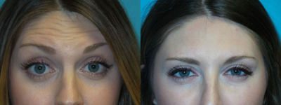 Botox before and after photo