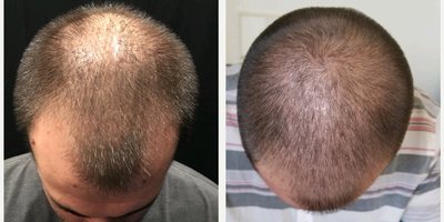Hair Loss Treatment before and after photo