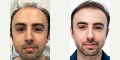 Hair Loss Treatment before and after photo