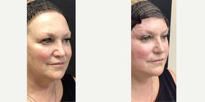 Thread Lift before and after photo