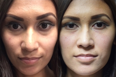 Dermal Fillers before and after photo