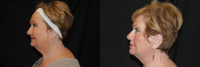 Facelift Revision before and after photo