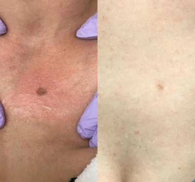 IPL before and after photo