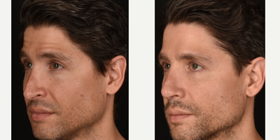 Revision Rhinoplasty before and after photo