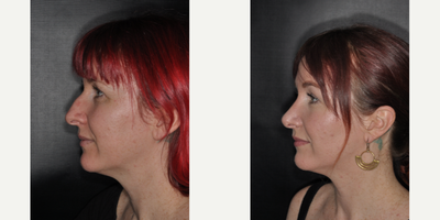 Rhinoplasty before and after photo