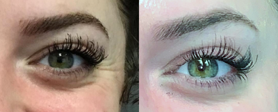 Botox before and after photo
