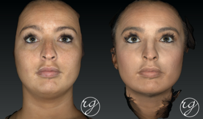 Dermal Fillers before and after photo