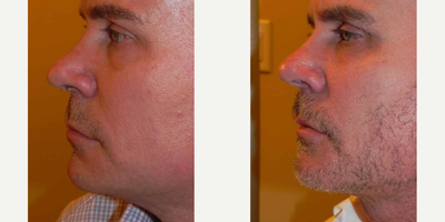 Kybella before and after photo