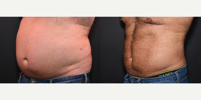 Liposuction before and after photo