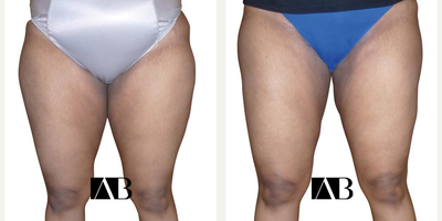 Liposuction before and after photo