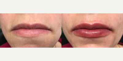 Restylane before and after photo