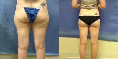 Smart Lipo before and after photo