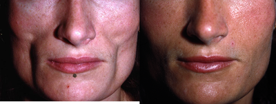 Dermal Fillers before and after photo
