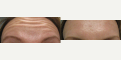 Dysport before and after photo