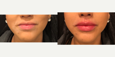 Juvederm before and after photo