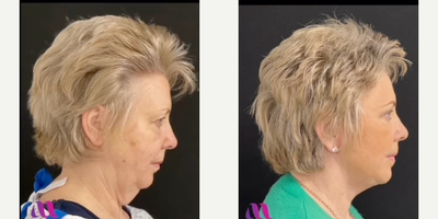 Neck Lift before and after photo