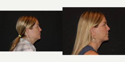 Facelift before and after photo