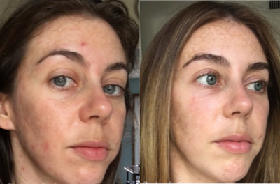 Restylane before and after photo