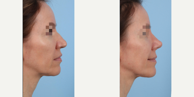 Rhinoplasty before and after photo