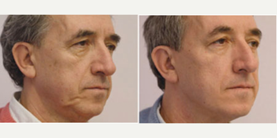 Thread Lift before and after photo
