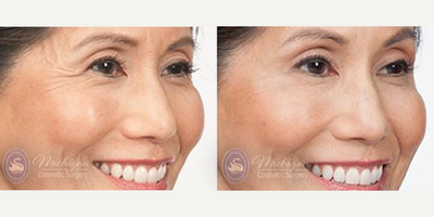 Botox before and after photo