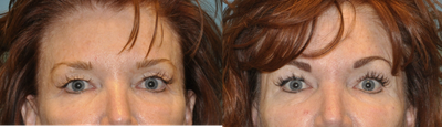 Eyelid Surgery before and after photo