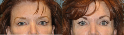 Eyelid Surgery before and after photo