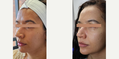Botox before and after photo