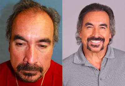 Hair Transplant before and after photo