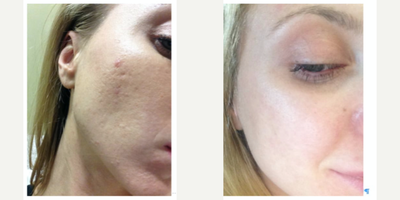 Microneedling before and after photo