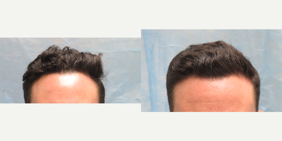 PRP for Hair Loss before and after photo