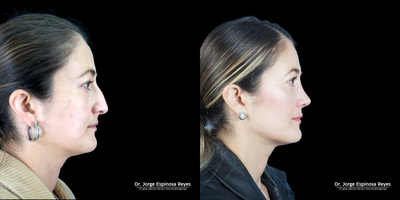 Rhinoplasty before and after photo