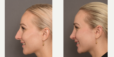 Rhinoplasty before and after photo