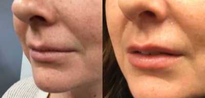 Dermal Fillers before and after photo