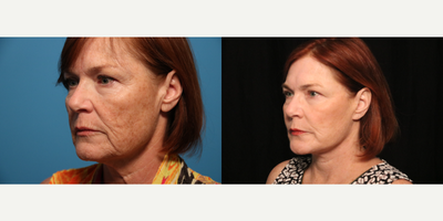 Facelift before and after photo