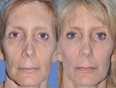 Facial Fat Transfer before and after photo