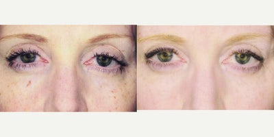 Laser Resurfacing before and after photo