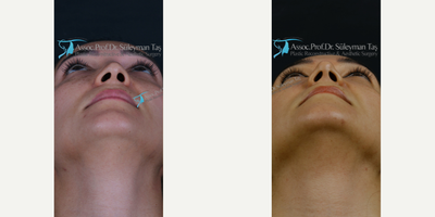 Revision Rhinoplasty before and after photo