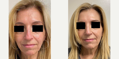Rhinoplasty before and after photo