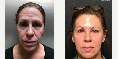 Sculptra before and after photo