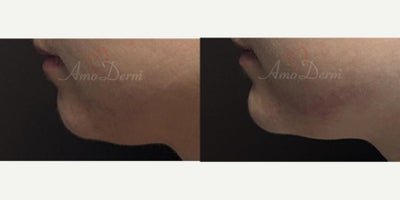 Chin Filler before and after photo